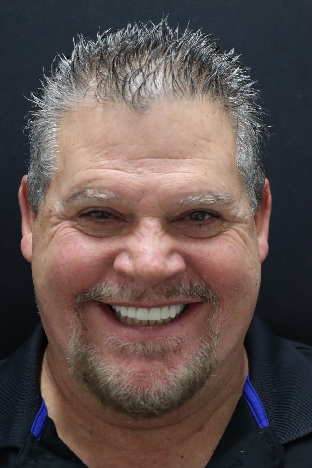 The Dental Atelier Full Smile Restoration — before treatment, patient 3