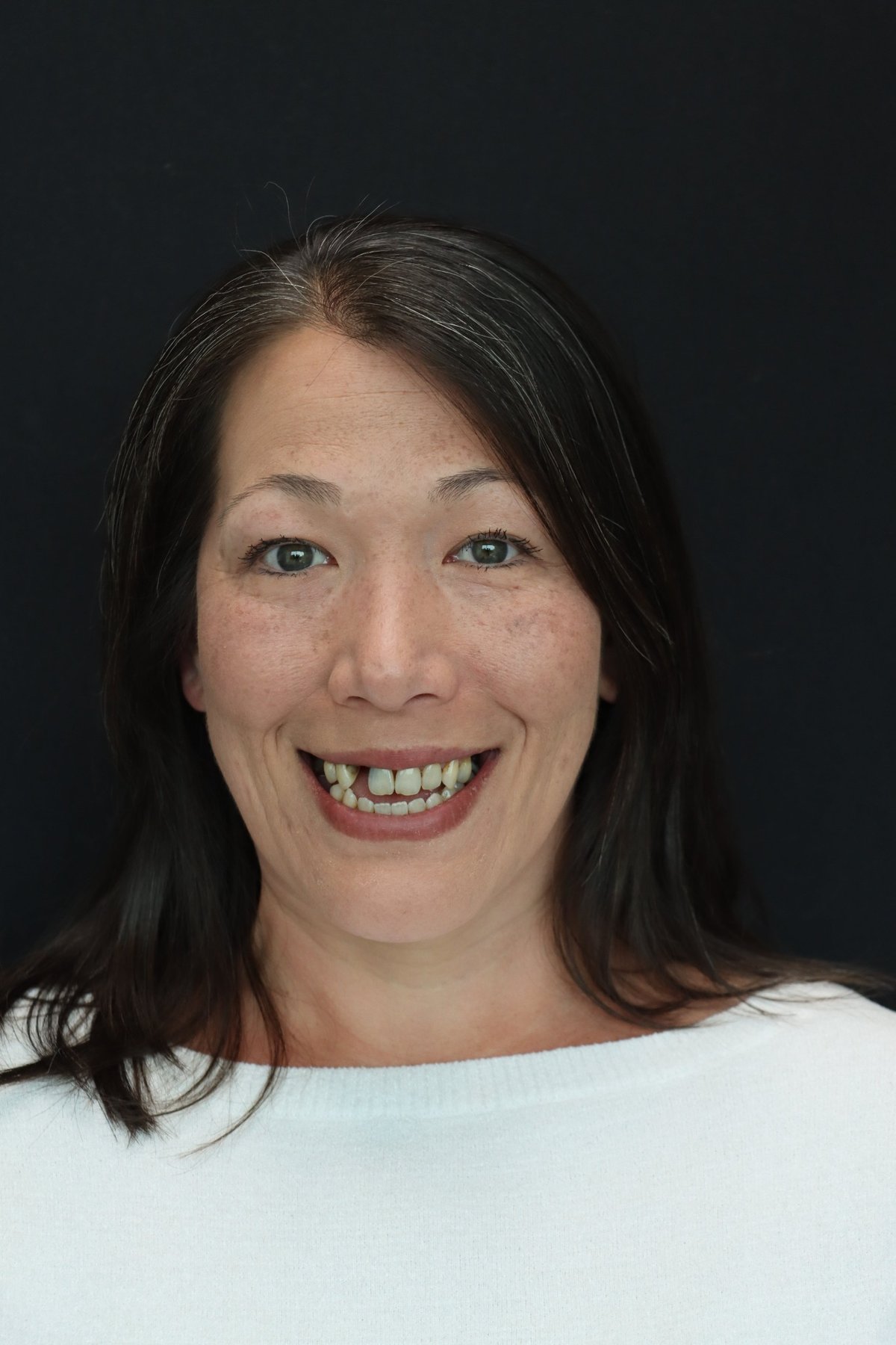 The Dental Atelier Smile Makeover — before treatment, patient 2